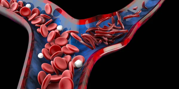 Anemia drepanocítica, que muestra vasos sanguíneos con media luna normal y deformada. Ilustración 3D —  Fotos de Stock