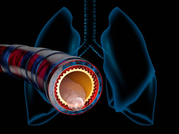 Anatomía de la bronquitis, mucosidad secretada como un resfriado en el pecho como ilustración 3D — Foto de Stock