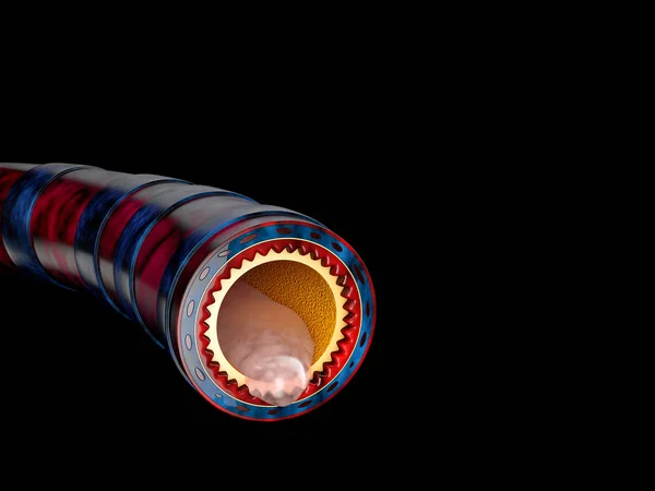 支气管炎解剖学，粘液分泌为胸部感冒作为3D插图 — 图库照片