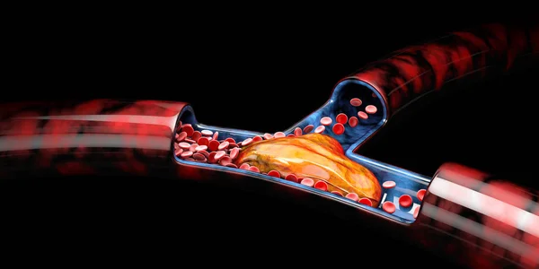 Derin Ven Trombozu veya Kan Pıhtıları 3d İllüstrasyon, Emboli izole siyah