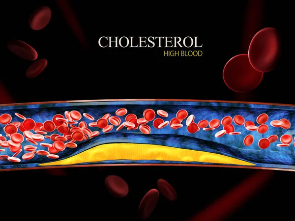 3d Illustrazione delle cellule del sangue con accumulo di placca di colesterolo — Foto Stock