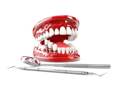 Diş insan implantı. Diş kavramı 3d illüstrasyon