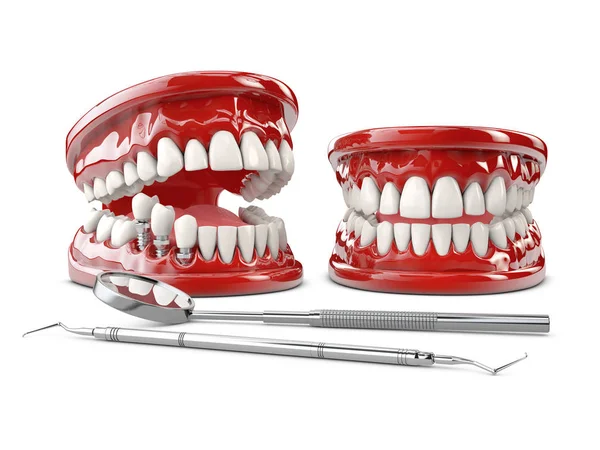 Tand humant implantat. Dental Concept 3D illustration — Stockfoto