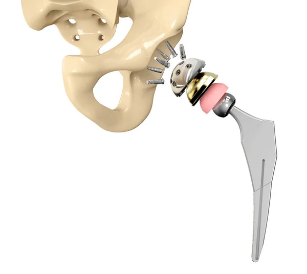 骨盤骨に取り付けられた股関節置換インプラントの3Dイラスト — ストック写真