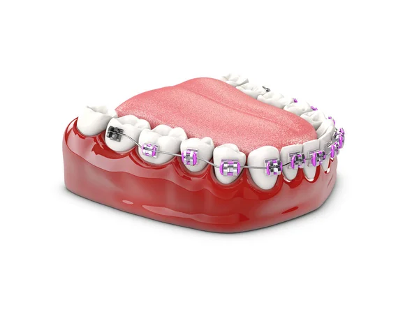 Tanden met haakjes, Dental Care concept 3D illustratie — Stockfoto