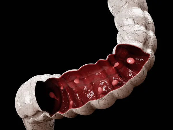 Pólipos de cólon. ilustração 3d, pólipo no intestino . — Fotografia de Stock