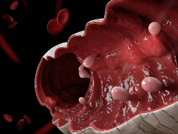 Pólipos de colon. Ilustración 3d, pólipo en el intestino . — Foto de Stock