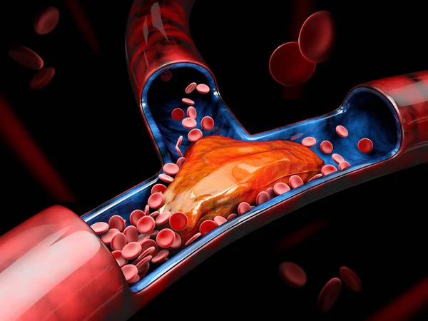 3D-ілюстрація тромбозу глибокої вени або тромбів крові. емболізм — стокове фото