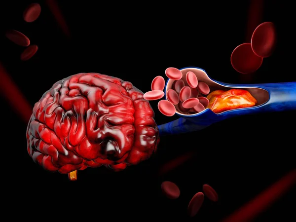 Ilustração 3D de Trombose de Veia Profunda ou Fendas de Sangue. Embolismo — Fotografia de Stock