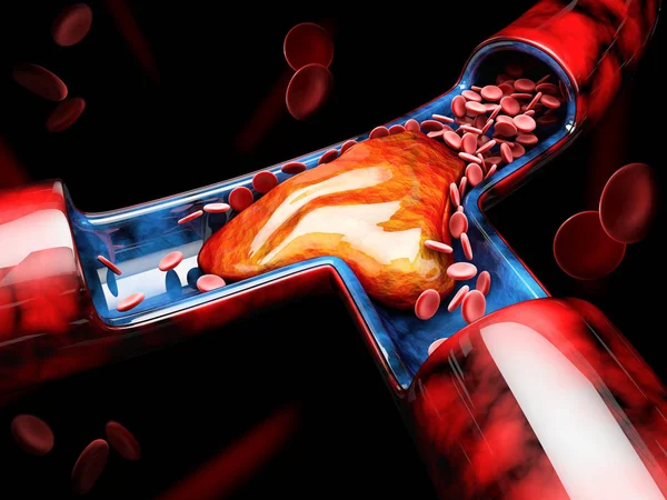 3D απεικόνιση της θρόμβωσης ή θρόμβων στο αίμα. Εμβολή — Φωτογραφία Αρχείου