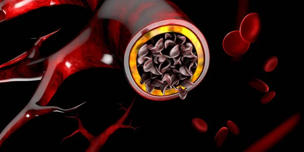 Серповидноклітинна анемія, що показує кровоносні судини з нормальним і деформованим півмісяцем. 3D ілюстрація — стокове фото