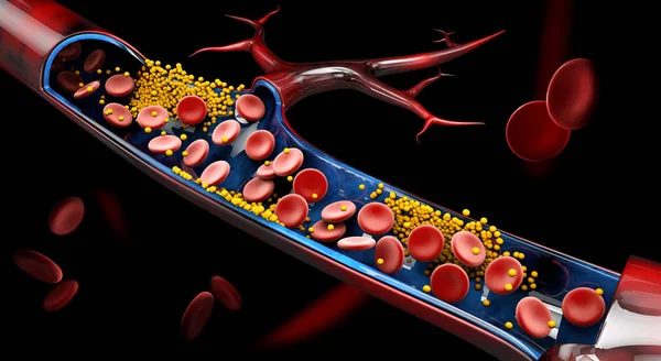 3D-Illustration von Blutzellen mit Plaque-Ansammlung von Cholesterin. — Stockfoto