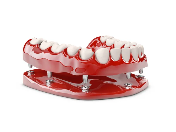 Menselijke tanden en Dental implant. 3D illustratie — Stockfoto