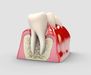 İnsan diş, diş implantı, stok 3d illüstrasyon.