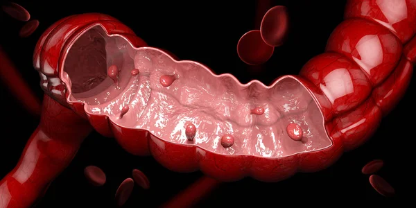 Illustrazione 3d dei polipi del colon. Polipi nell'intestino. isolato nero .. — Foto Stock