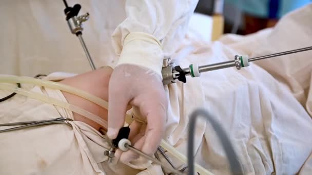 Dicht zicht op Laparoscopische appendectomie operatie in het regionale kinderziekenhuis — Stockvideo