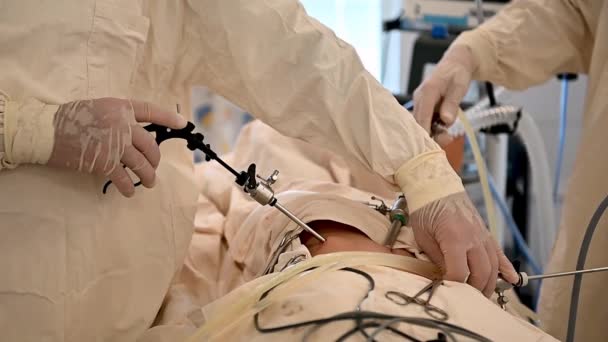 Vista da vicino dell'operazione di appendicectomia laparoscopica presso l'ospedale regionale per bambini — Video Stock