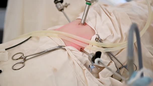 Asistent asistuje chirurgovi při operaci Laparoskopická apendektomie — Stock video