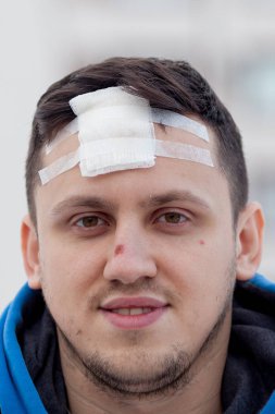 Kafatasında kabloyla dikiş izi, ameliyat sonrası dikiş kraniektomisi, bir sürü zımba ve dikiş teknolojisi..