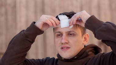 Kafatasında kabloyla dikiş izi, ameliyat sonrası dikiş kraniektomisi, bir sürü zımba ve dikiş teknolojisi..