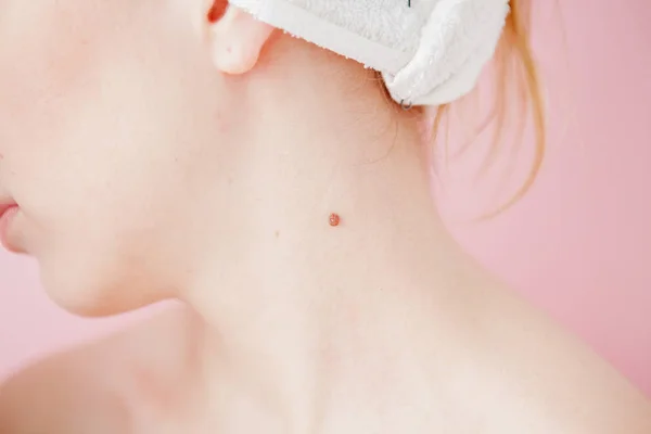 Tek bir bölüm altında onun saç çizgisi ile üç benler ortaya çıkarmak için bağladım saçları ile görünümü bir kadın boyun arkasında bir kadın kadar yakın.