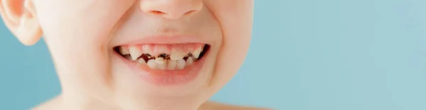 Close up shot of baby teeth with caries — Stock Photo, Image