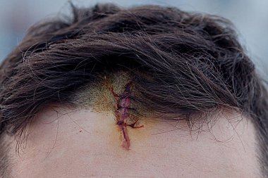 Kafatası telleri ile Postoperative cranie dikiş yarası dikiş