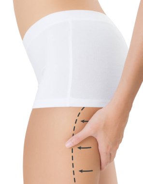 Çizim siyah oklar, kilo kaybetmek ve liposuction ile arka uyluk sıkma kadın beyaz arka plan üzerinde izole selülit kaldırma kavramı,.