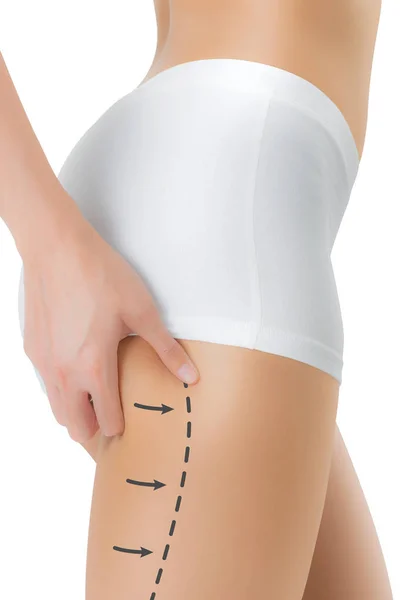 Woman grabbing skin on her flanks with the black color crosses marking,  Lose weight and liposuction cellulite removal concept, Isolated on white  backg Stock Photo - Alamy