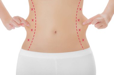 Kadın onun yanları kırmızı renk ile ciltte kapma işaretleme, kaybetmek ağırlık ve liposuction selülit kaldırma kavramı, göl kenarında beyaz arka plan üzerinde haçlar.