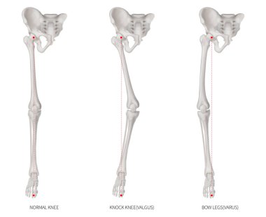 Hizalama türleri hastalık alt yarısı ekstremite veya bacak kemik sorun-Normal-Knock diz ve Bowlegs veya Valgus ve Varus diz - 3d tıbbi illüstrasyon insan anatomi ve eğitim kavramı beyaz arka plan