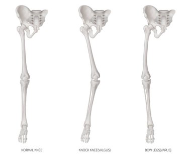 Türleri hastalık alt yarısı ekstremite veya bacak kemik sorun-Normal-Knock diz ve Bowlegs veya Varus ve Valgus diz - 3d tıbbi illüstrasyon insan anatomi ve eğitim izole kavramı beyaz arka plan
