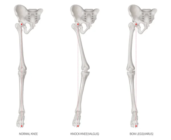 Hizalama türleri hastalık alt yarısı ekstremite veya bacak kemik sorun-Normal-Knock diz ve Bowlegs veya Valgus ve Varus diz - 3d tıbbi illüstrasyon insan anatomi ve eğitim kavramı beyaz arka plan