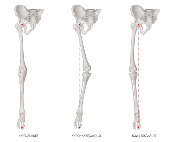 Tipos Alinhamento Doença Membros Inferiores Problema Osso Perna Normal Knock — Fotografia de Stock