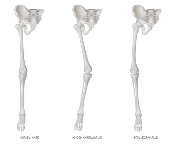 Türleri hastalık alt yarısı ekstremite veya bacak kemik sorun-Normal-Knock diz ve Bowlegs veya Varus ve Valgus diz - 3d tıbbi illüstrasyon insan anatomi ve eğitim izole kavramı beyaz arka plan