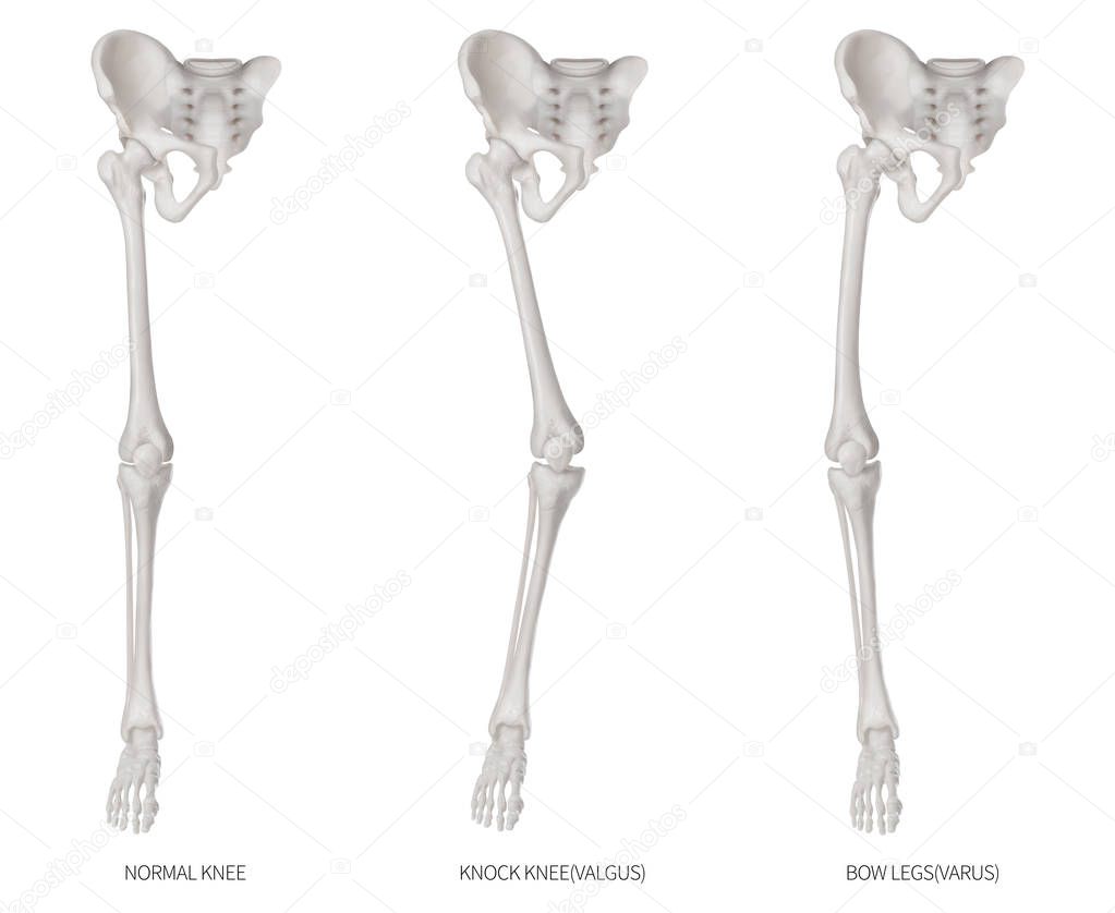 Types disease of lower half limbs or leg bone problem- Normal- Knock knee and Bowlegs or Valgus and Varus knee- 3D medical illustration- human anatomy and educational concept-Isolated white background