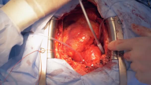 Real heart beats through open chest during surgery. — Stock Video