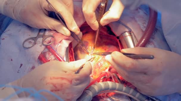 Latidos cardíacos reales durante una cirugía real. Cirugía cardiaca . — Vídeos de Stock