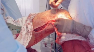 Operatif Cerrahi alan bacak bir cerrah tarafından keşfi.