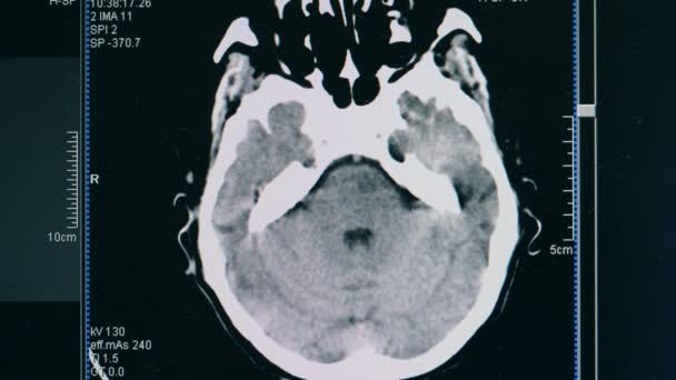 Escaneamento cerebral, de perto. Uma imagem de varredura de um cérebro de pacientes . — Vídeo de Stock