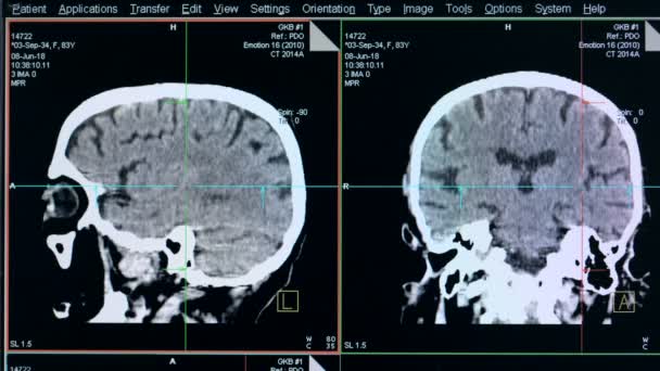 Сканирование головы, закрыть. Экран со сканированием головы на специальной машине в больнице . — стоковое видео