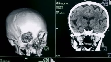 Kafatası modeli bir ekranda döner, yakın çekim. Tıbbi makine bir hasta kafatasının bir model oluşturur.