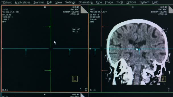 Proceso de escaneo cerebral, primer plano . — Vídeo de stock