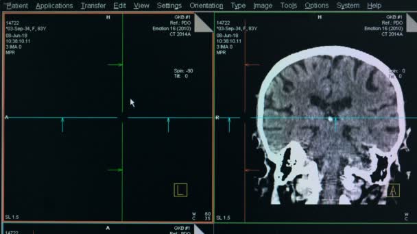 Prozess des Gehirnscans, Nahaufnahme. — Stockvideo