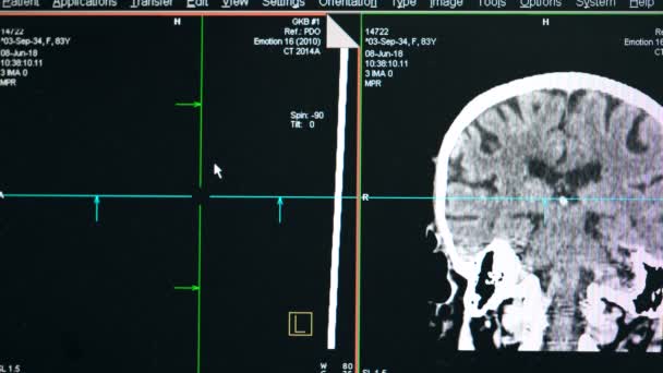 Imágenes de un escaneo cerebral, de cerca . — Vídeo de stock