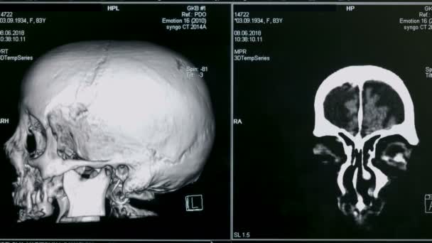 Exploración 3D de un cerebro, de cerca. Un equipo especial escanea el cerebro de un paciente en una clínica . — Vídeos de Stock