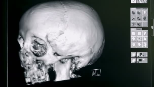 3D model lebky, zblízka. Nemocniční zařízení vytvoří 3d model lebky osob. — Stock video