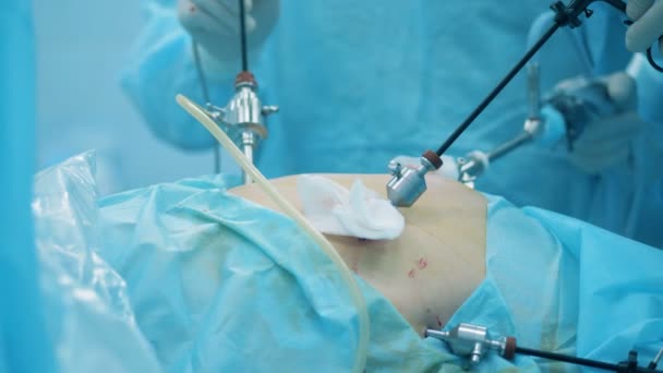 Close-up dos pacientes abdômen durante a operação — Vídeo de Stock