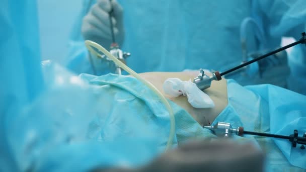 Laparoskopie je prováděna na lidský žaludek — Stock video