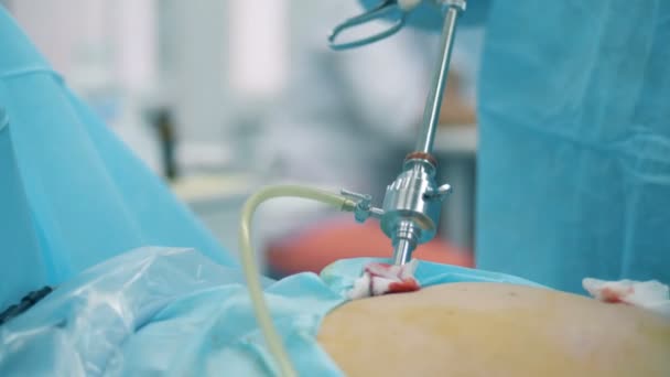 Procedimento laparoscópico está sendo realizado em uma cavidade abdominal — Vídeo de Stock
